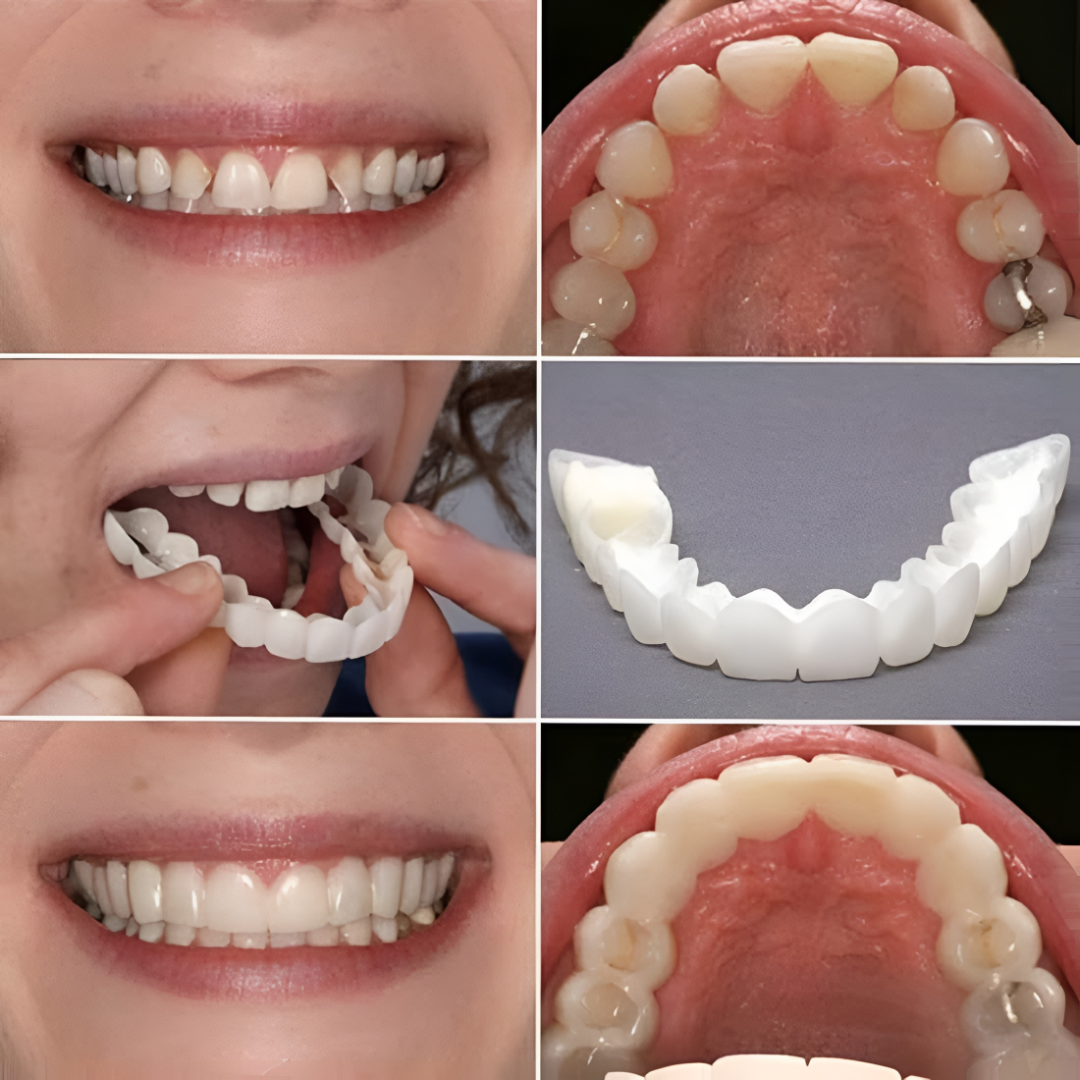 Carillas para dientes con acabado blanco natural